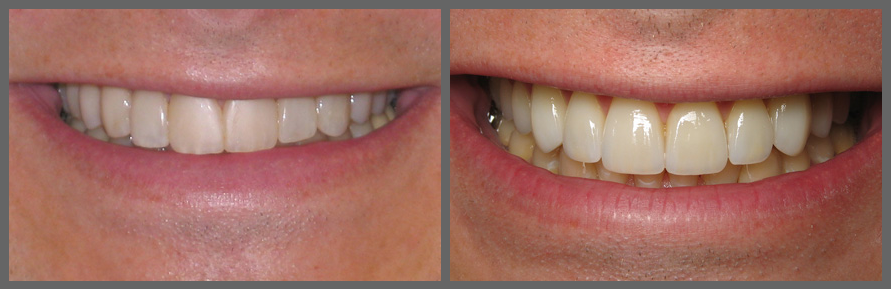 Установка виниров