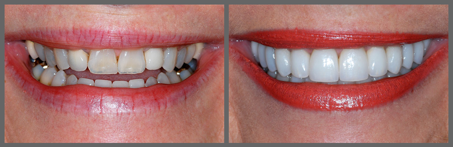 Виниры на зубы