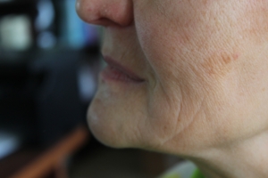 Съемные протезы