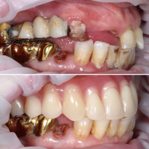 Цена съемного протезирования зубов