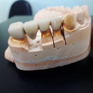 Установка металлокерамики