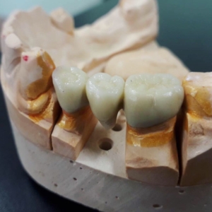 Протезирование зубов металлокерамикой