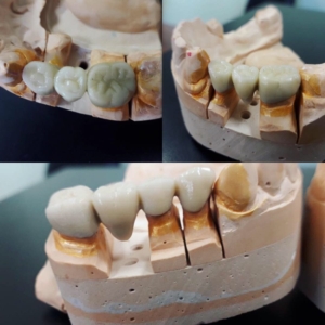 Цена установки металлокерамики
