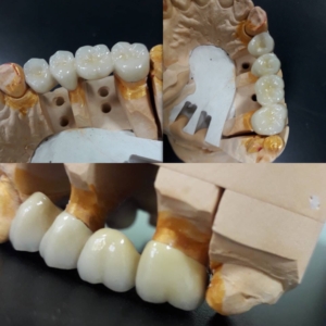 Профессиональная установка металлокерамики