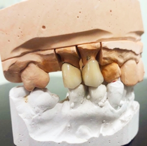 Записаться на установку металлокерамики