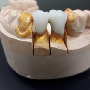 Услуги установки металлокерамики