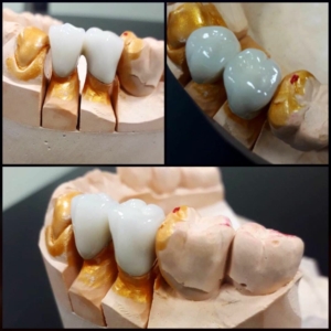 Записаться на протезирование зубов металлокерамикой