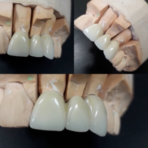 Несъемное протезирование