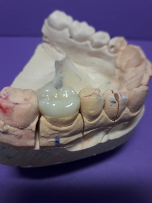 Циркониевые коронки