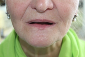 Съемные зубные протезы