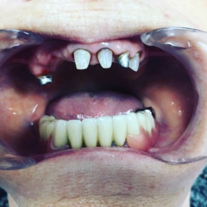 Несъемное протезирование зубов на имплантах