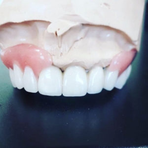 Записаться на протезирование зубов на имплантах