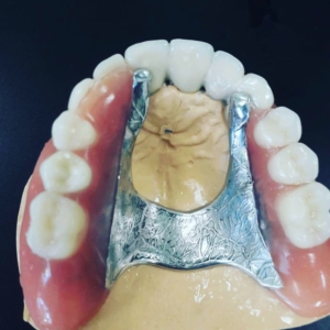 Стоимость несъемного протезирование зубов на имплантах