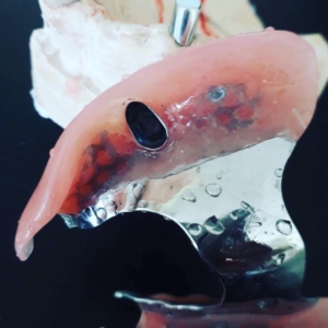 Услуги несъемного протезирования зубов на имплантах