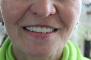 Полное съемное протезирование зубов