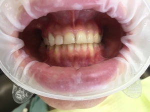 Установка коронки на зуб