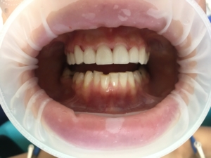 Коронка на зуб