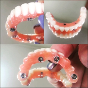 Полное съемное протезирование зубов