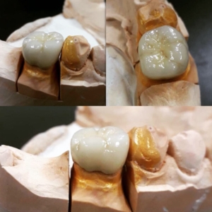 Качественное протезирование металлокерамикой