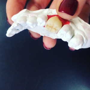 Керамическая коронка из прессованной керамики e-max