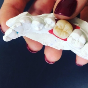 Керамическая коронка из прессованной керамики e-max 1