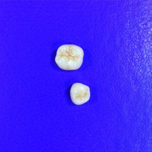 Коронка из керамики e-max