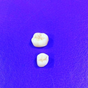 Коронка из керамики e-max 1