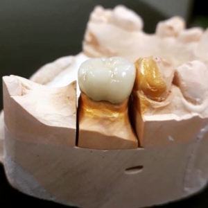 Профессиональная установка металлокерамики