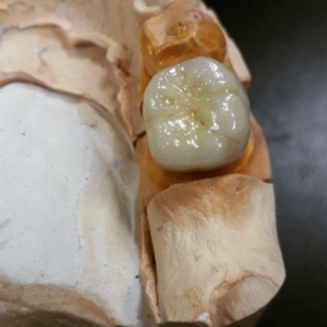 Протезирование