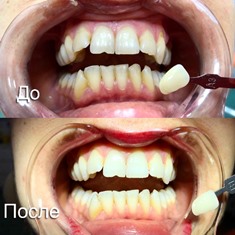 Отбеливание