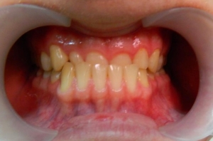 Исправление прикуса