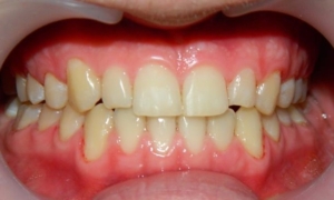 Исправление прикуса у взрослых