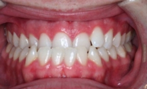 Цена исправления прикуса