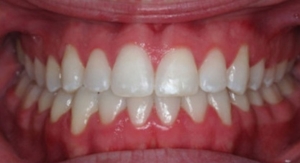 Профессиональное исправление прикуса