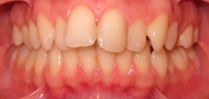 Исправление прикуса брекетами