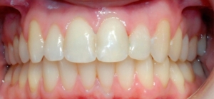 Записаться на исправление зубов брекетами