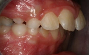 Профессиональное исправление прикуса брекетами