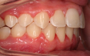 Стоимость исправления прикуса брекетами