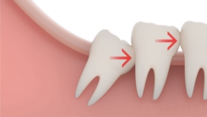 Стоимость удаления зуба мудрости