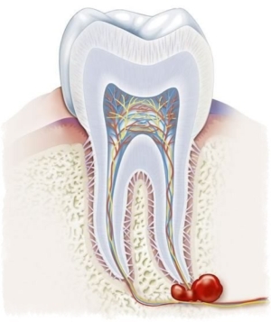 Удаление кисты зуба