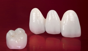 Протезирование винирами